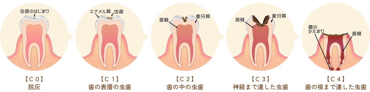 虫歯の進行