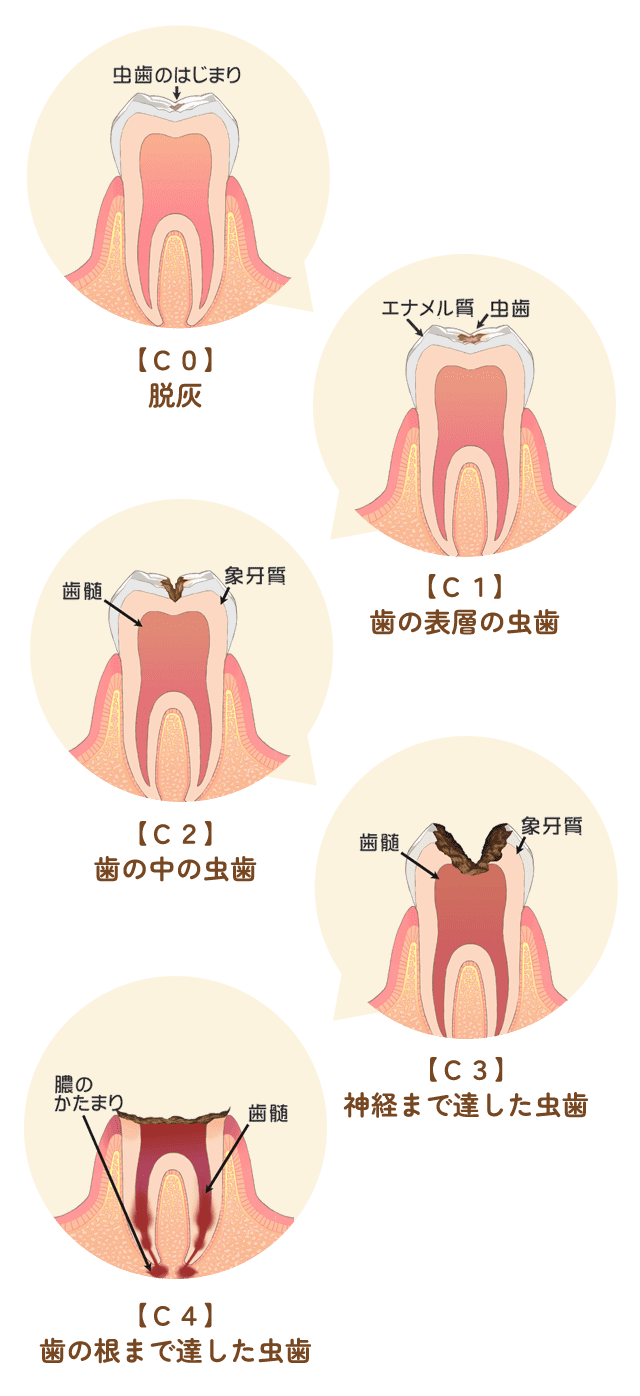 虫歯の進行